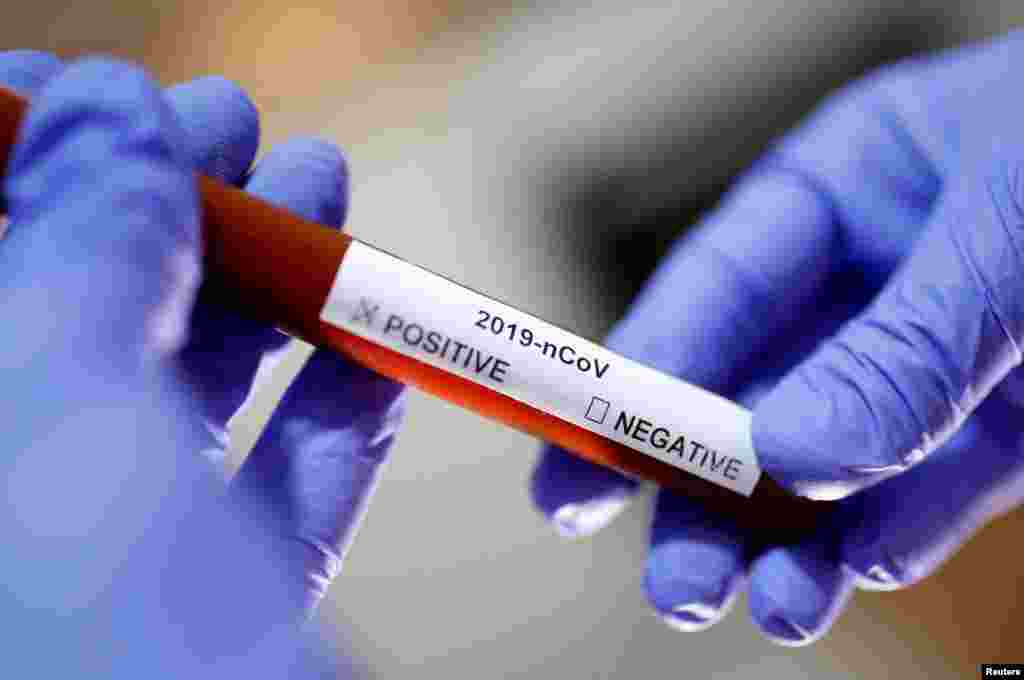 Hoy uno de los mayores desafíos lo tienen los pacientes que se infectaron con COVID-19 y continúan padeciendo efectos a largo plazo. Estos síntomas de larga data son conocidos entre otros términos como COVID-19 persistente, COVID-19 de larga duración, COVID-19 posagudo o COVID-19 crónico.