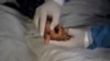 México y Cuba reportan inusuales muertes de dos pacientes con viruela del mono