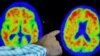 Un médico señala evidencia de la enfermedad de Alzheimer en exploraciones PET en el Centro de Investigación y Tratamiento del Alzheimer (CART) en el Hospital Brigham And Women's en Boston, Massachusetts, EE. UU., 30 de marzo de 2023. REUTERS/Brian Snyder/