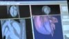 3-D Printers Help Heart Surgeons