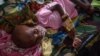 FILE - A Papuan child suffering from malnutrition lies in a hospital bed for treatment in Agats, the capital of Asmat district in Indonesia's easternmost Papua province, Jan. 26, 2018.