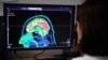 Escáner del cerebro de una persona en una pantalla de un hospital de Brest, al oeste de Francia.