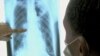An x-ray of the lungs of a TB patient