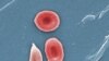 Pacientes con células falciformes piden protección contra COVID-19